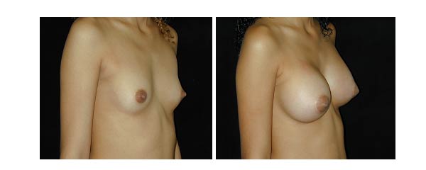 breastaugmentation34.jpg