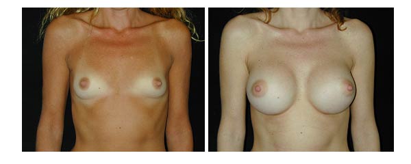 breastaugmentation35.jpg