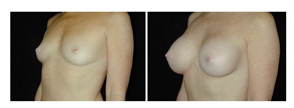 breastaugmentation38.jpg