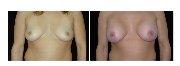 breastaugmentation39.jpg