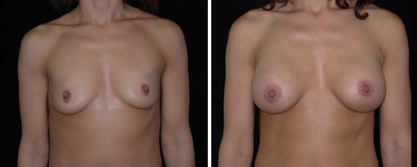 breastaugmentation40.jpg