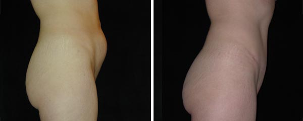 abdominoplasty17.jpg