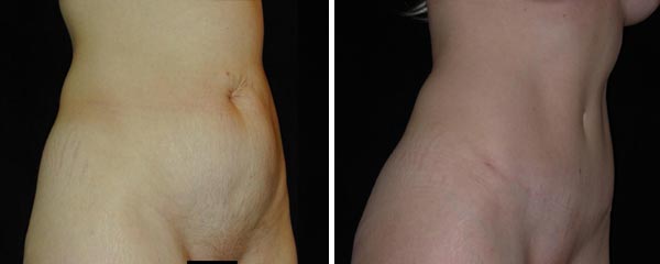 abdominoplasty18.jpg