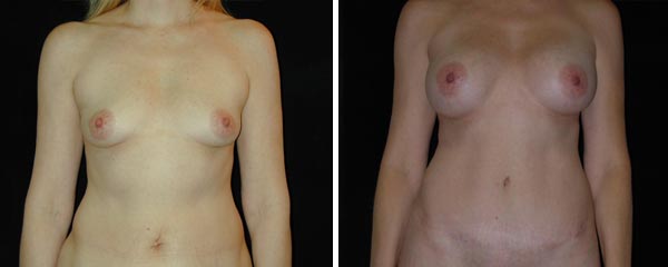 abdominoplasty19.jpg