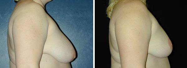 breastreduction01.jpg