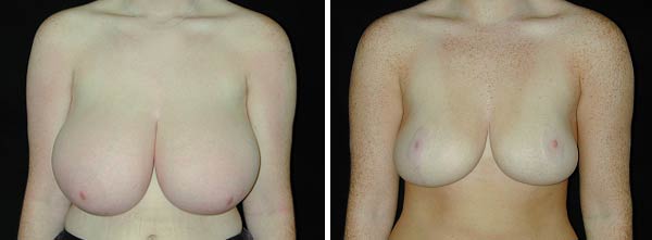breastreduction02.jpg