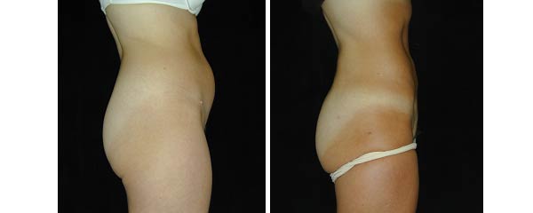 liposuction04.jpg