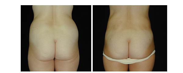 liposuction05.jpg