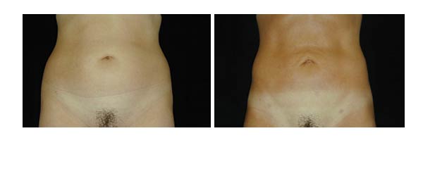 liposuction06.jpg