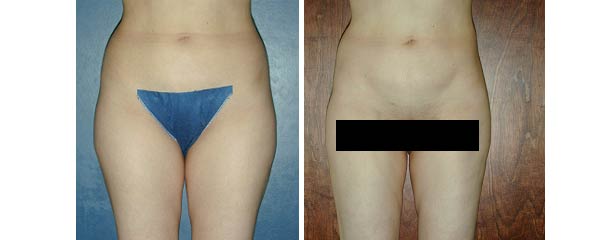 liposuction07.jpg