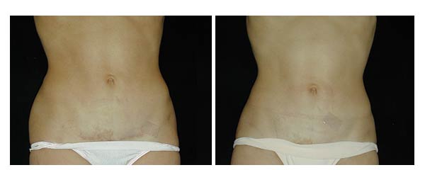 liposuction09.jpg