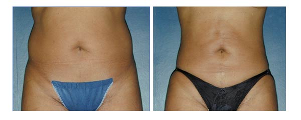 liposuction10.jpg