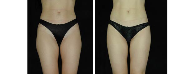 liposuction14.jpg