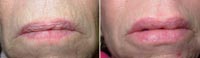 Lip Augmentation Delaware