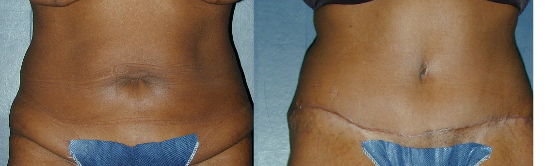 ABdominBA343.jpg