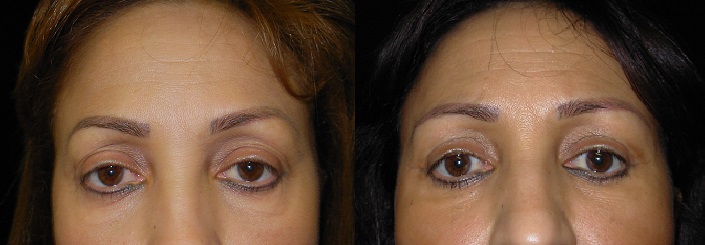 Eyelid Surgery