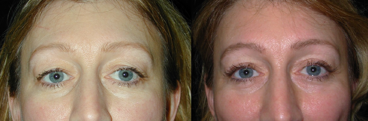 Upper Eyelid Surgery Philadelphia