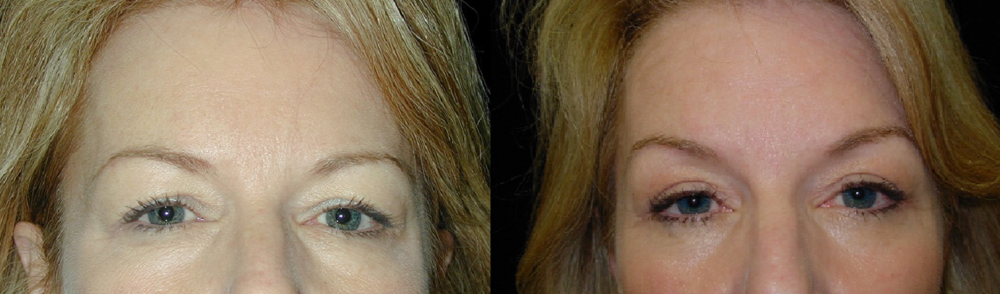 Eyelid Surgery Delaware