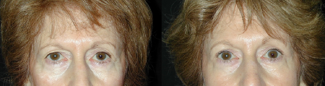 Eyelid Surgery New Jersey