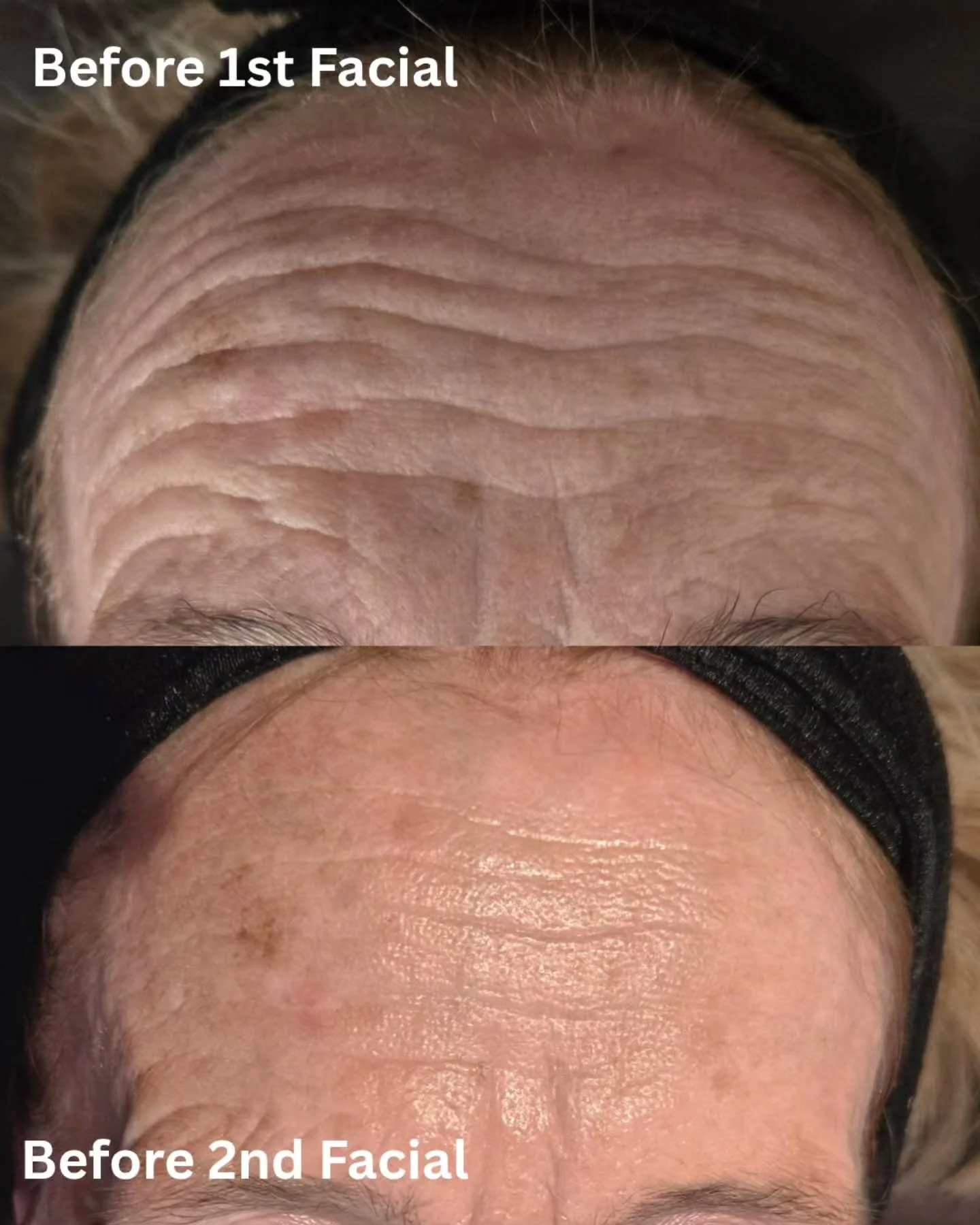 No skincare routine. Never had a facial. One month later&hellip; this!

This client came to me unsure where to start with her skin.
So we kept things simple:
✨ One professional Dermalogica facial
✨ A personalised Dermalogica homecare routine
✨ Consis