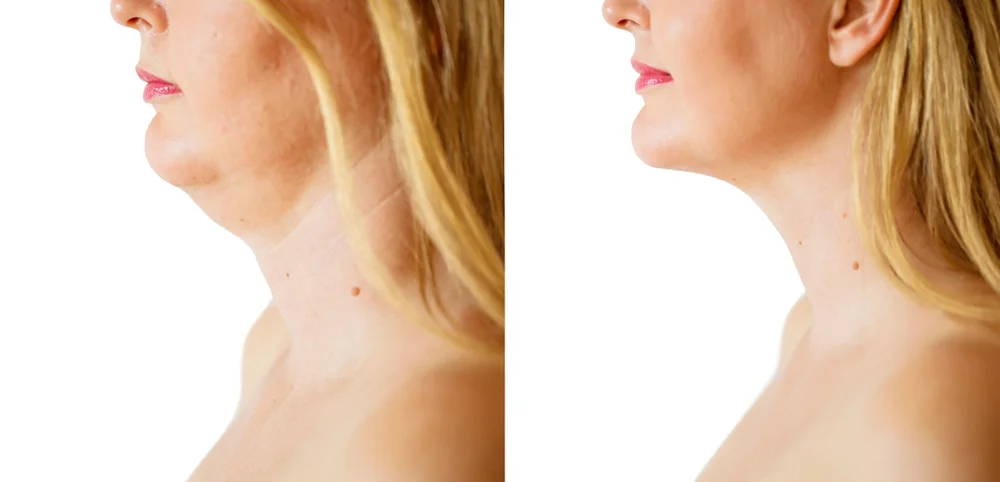kybella okc.jpg