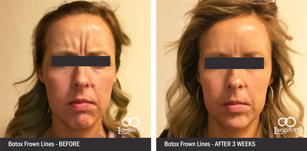 Botox-frown-lines-between-eyebrows-before-and-after.jpg