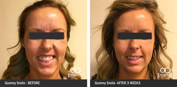 Botox-Before-and-After-gummy-smile-update.jpg