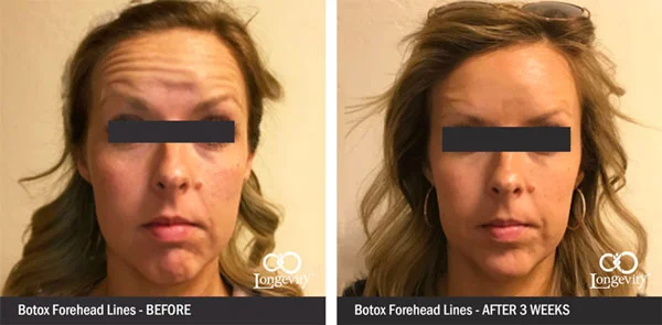 Botox-Before-and-AfterForehead-lines-for-webpage-2.jpg