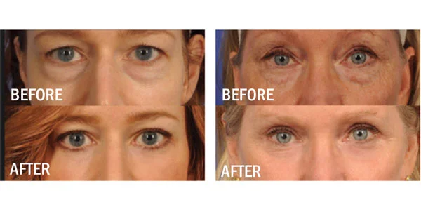 before-and-after-together-under-eye-update-thermi.jpg