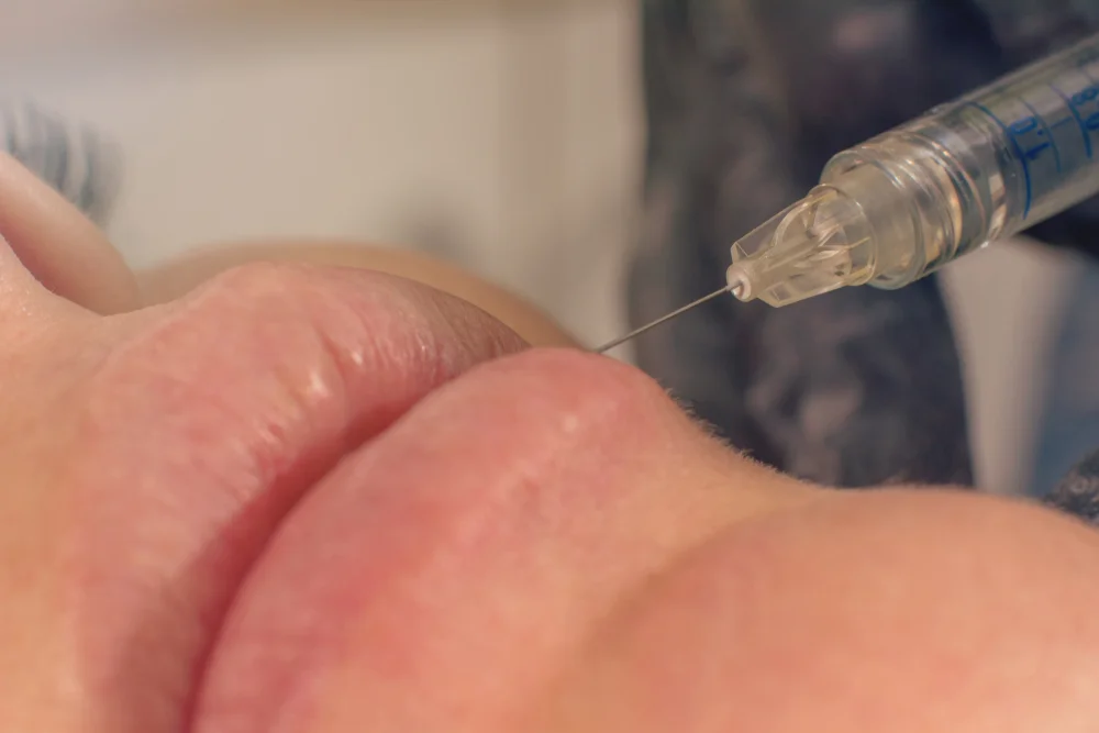 dermal fillers.jpg
