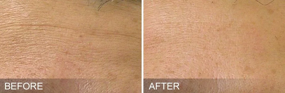 Hydrafacial™ uses intense hydration to remove fine lines and wrinkles. Add CTGF Boost for faster results.