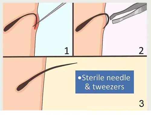 How To Prevent Ingrown Hairs On The Buttocks Butt Wax