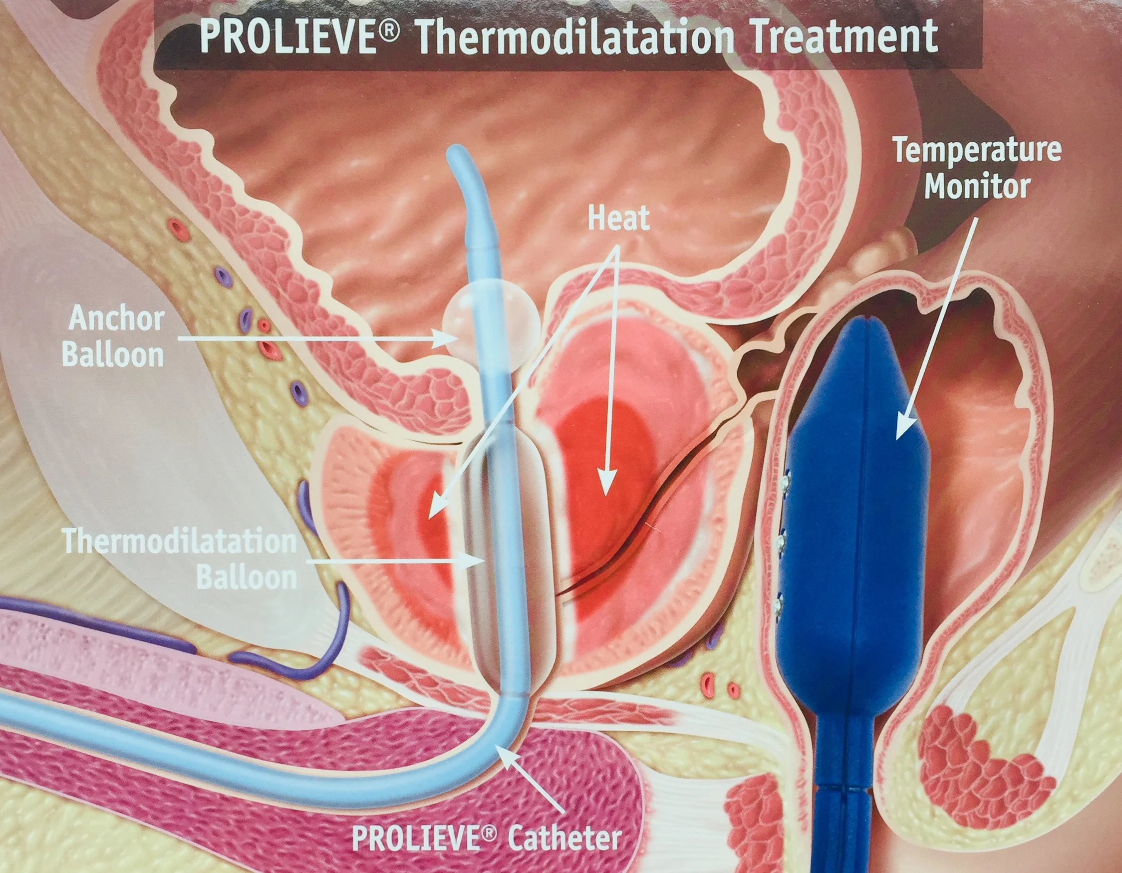 Prolieve microwave thermodilatation of prostate