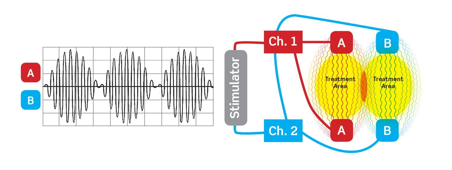 Premodulated INF signals (at left above) are pre-mixed in the device prior to entering the body and provide an expanded area of therapeutic benefit (at right above)