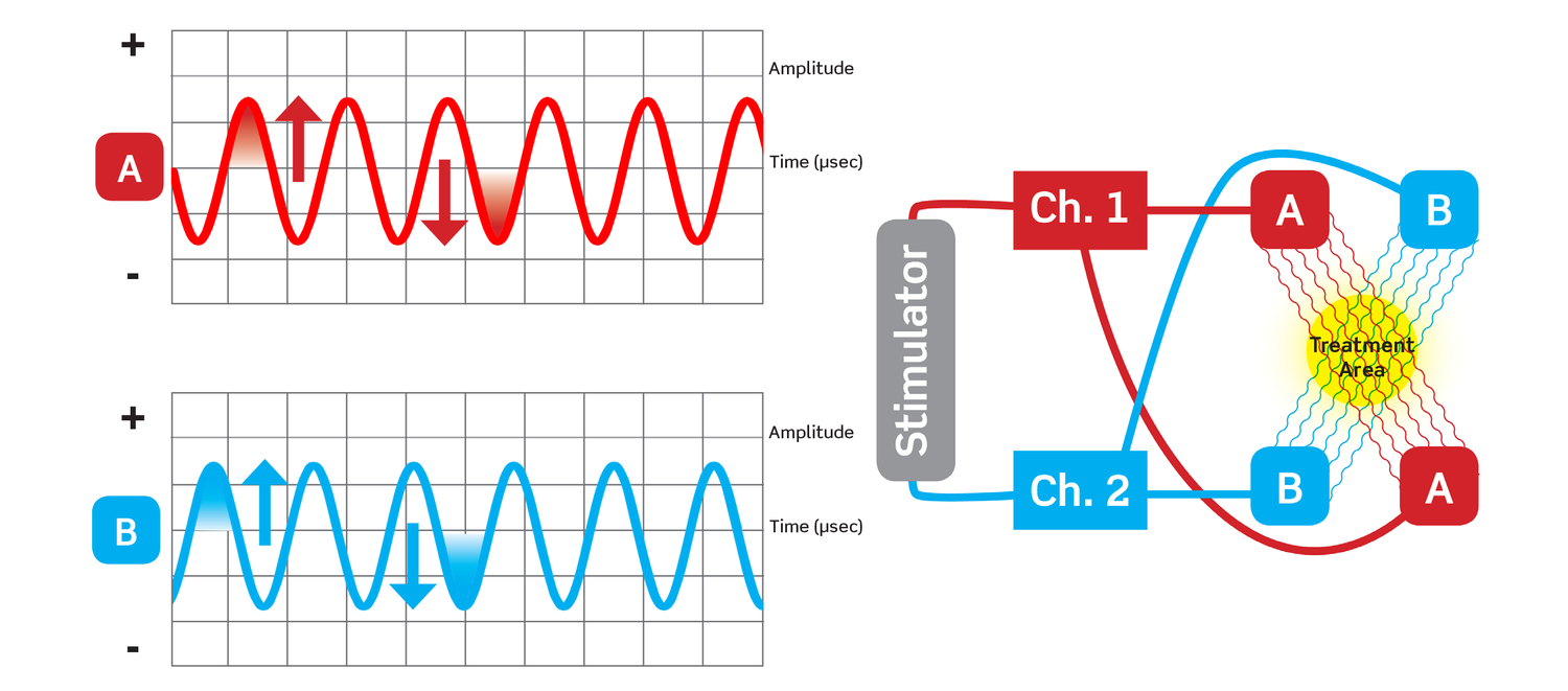 Traditional INF waveforms (at left above) cross in the body to create an area of interference that delivers pain relief in the treatment area (at right above)