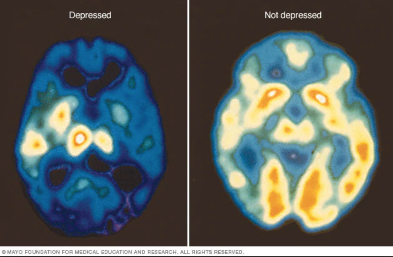 An increase of blue and green colors , along with decreased white and yellow areas, shows decreased brain activity due to depression.
