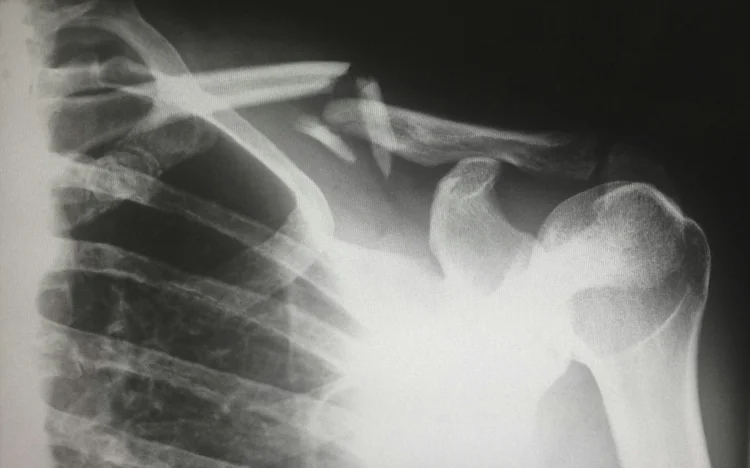 Shoulder x-ray