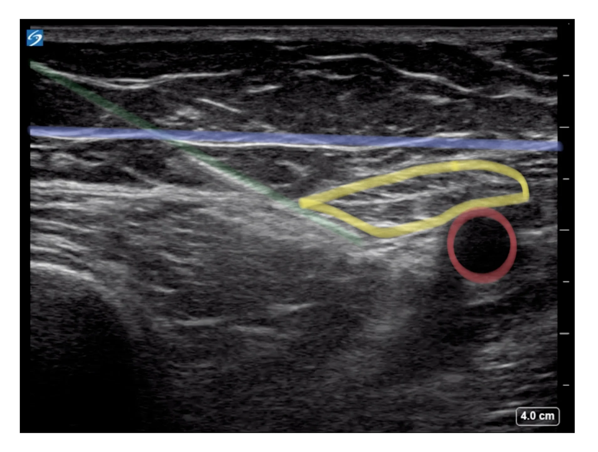 In-plane view of the FNB/FIB. The needle (green) is traversing the fascia iliaca (purple). The femoral nerve (yellow) is a triangular structure just lateral to the femoral artery (red).