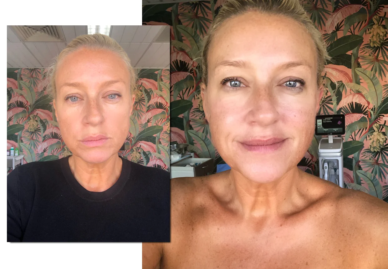 before-and-after-thermage.jpg