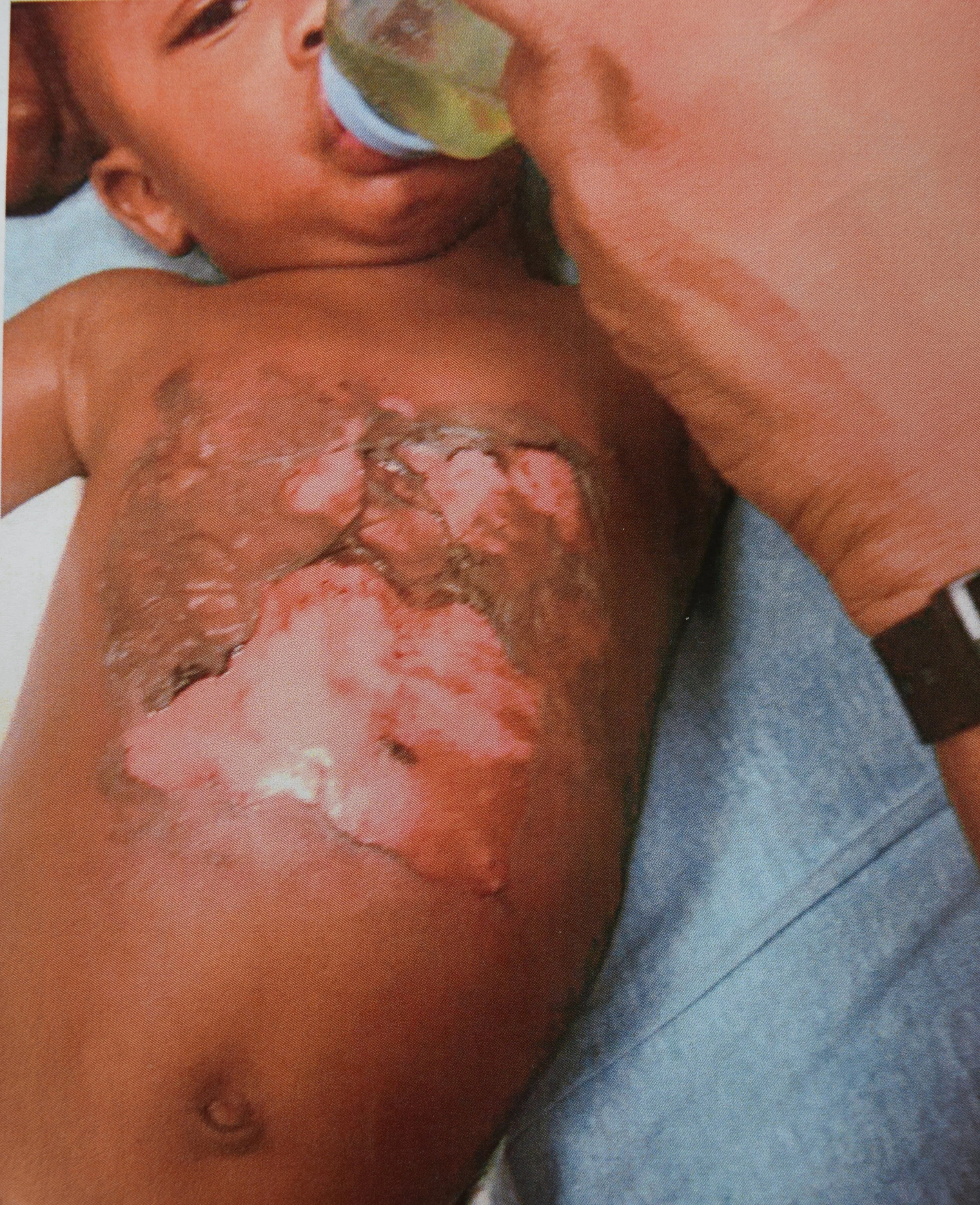 Baby burned by scalding hot water Applebee’s worker 