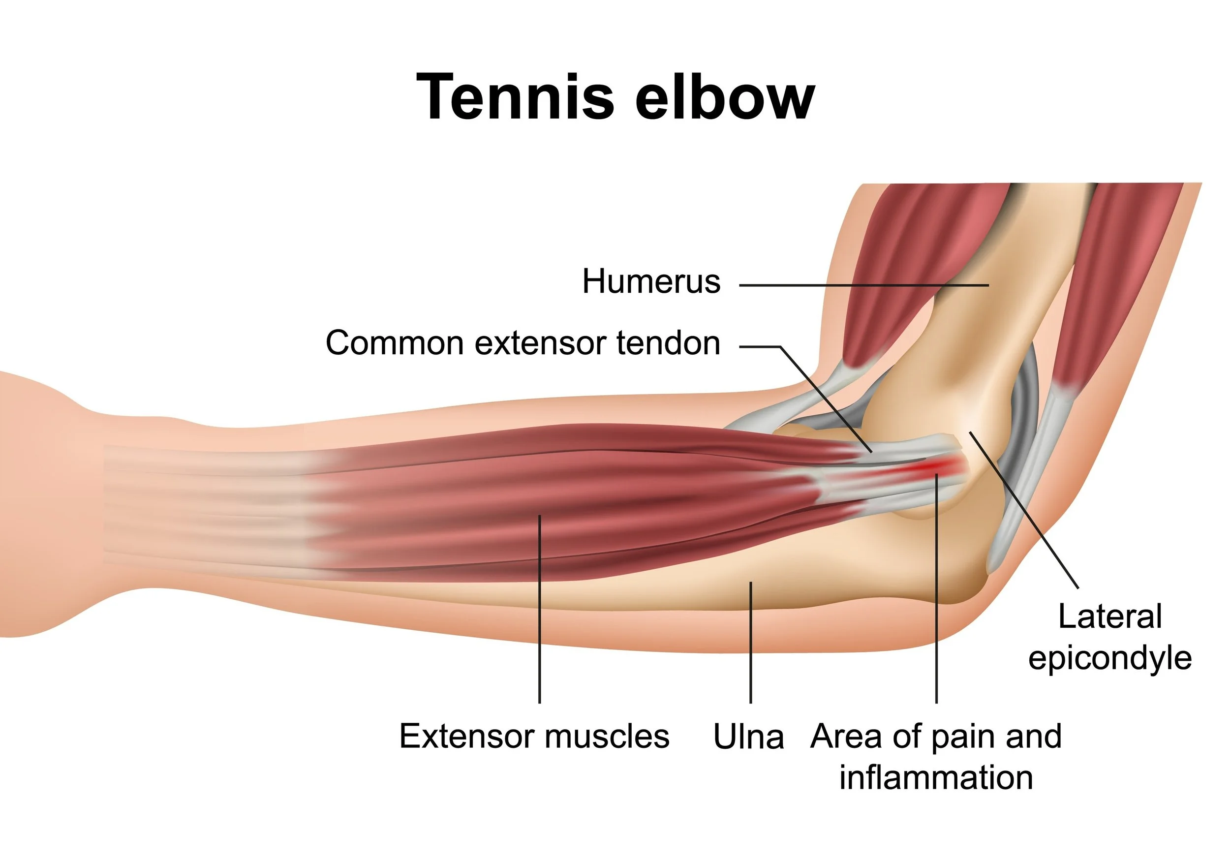 Elbow Pain When Gripping? It Might Be Tennis Elbow