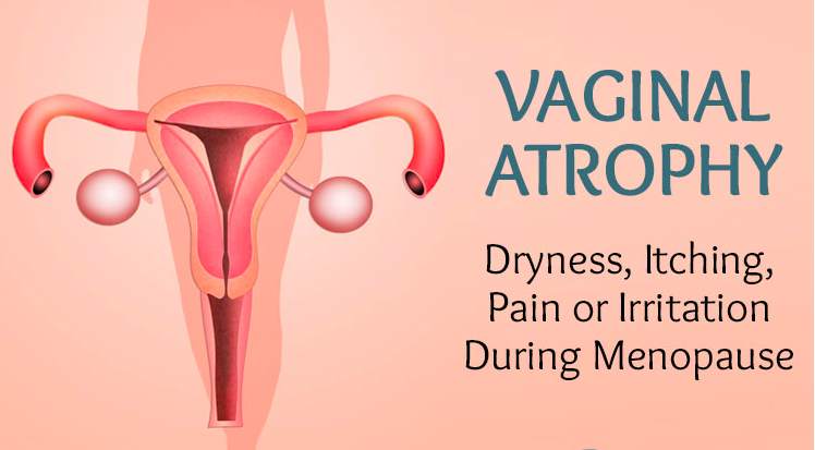 Painful sex and the menopause (or peri-menopause)