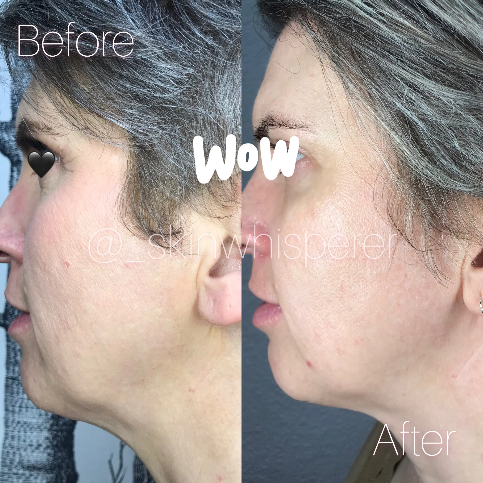 Skin Tightening