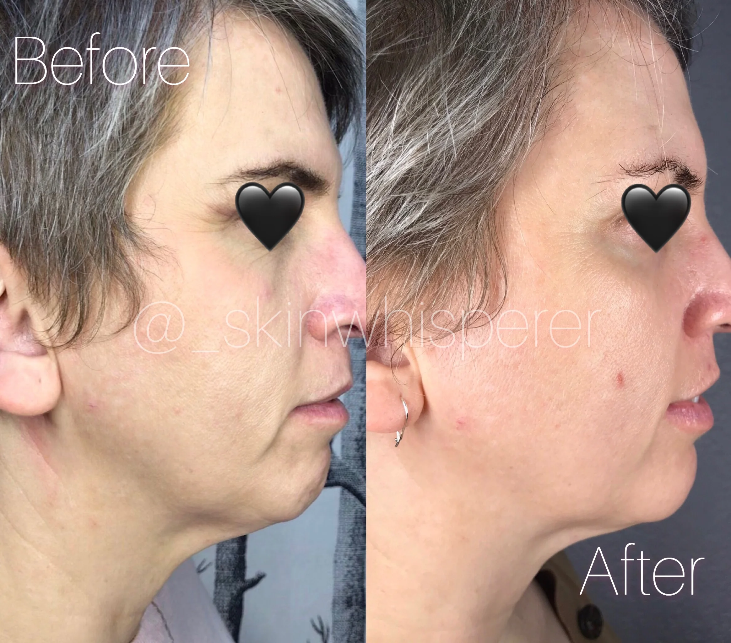 Holistic Face Lift