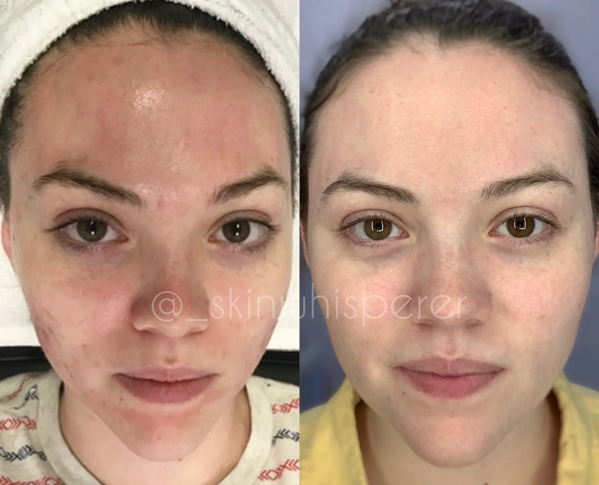 Cystic Acne Transformation in New Braunfels Austin San Antonio Gruene