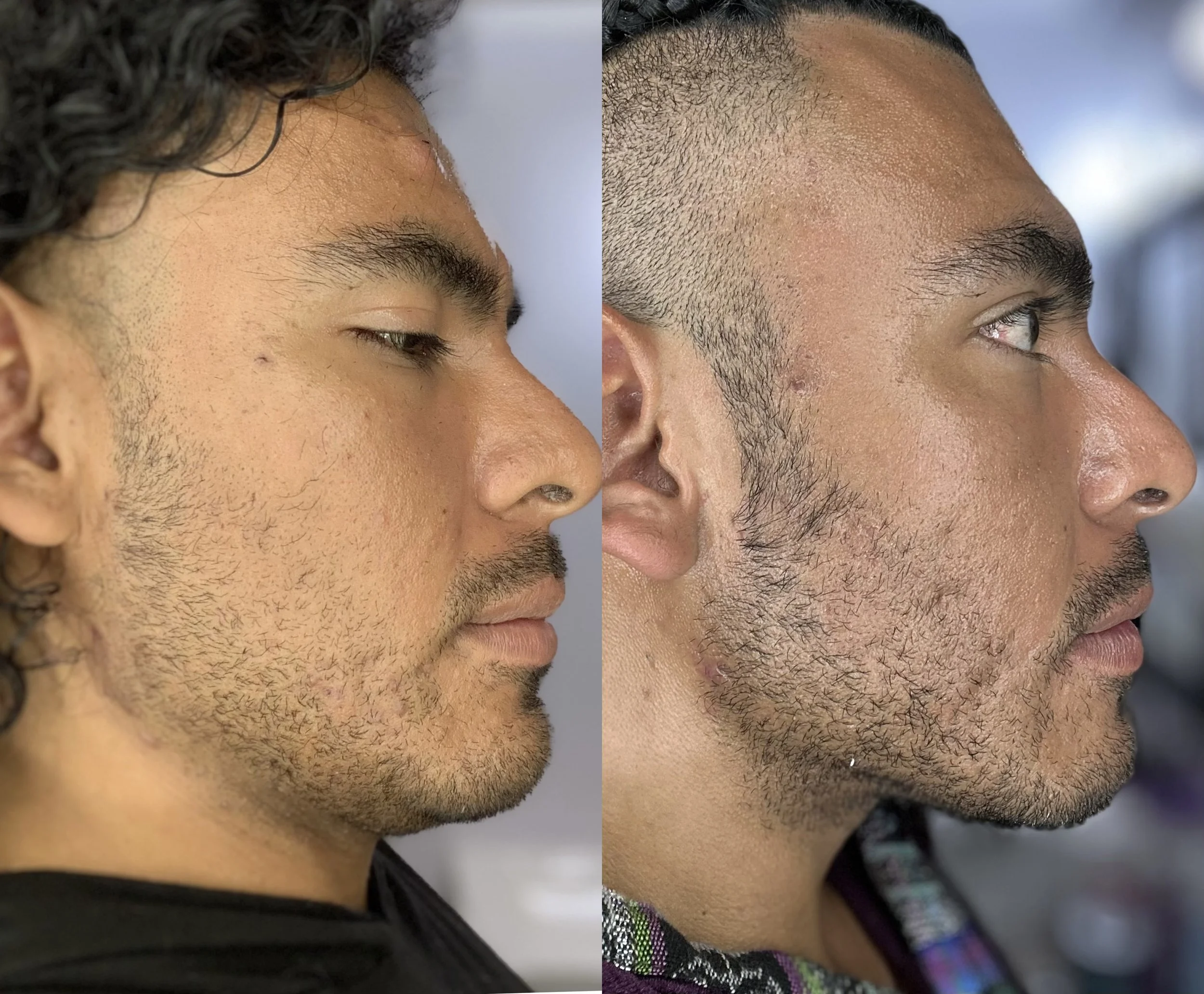 Double Chin Removal