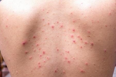 Body acne treatments