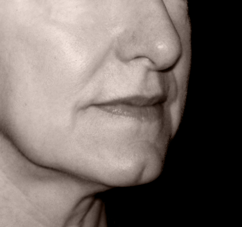 patient before Endotine Midface procedure with flat cheek