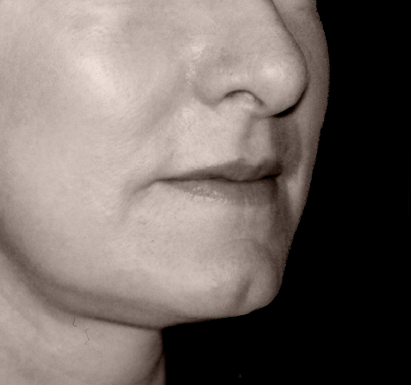 patient after Endotine Midface procedure with youthful cheek