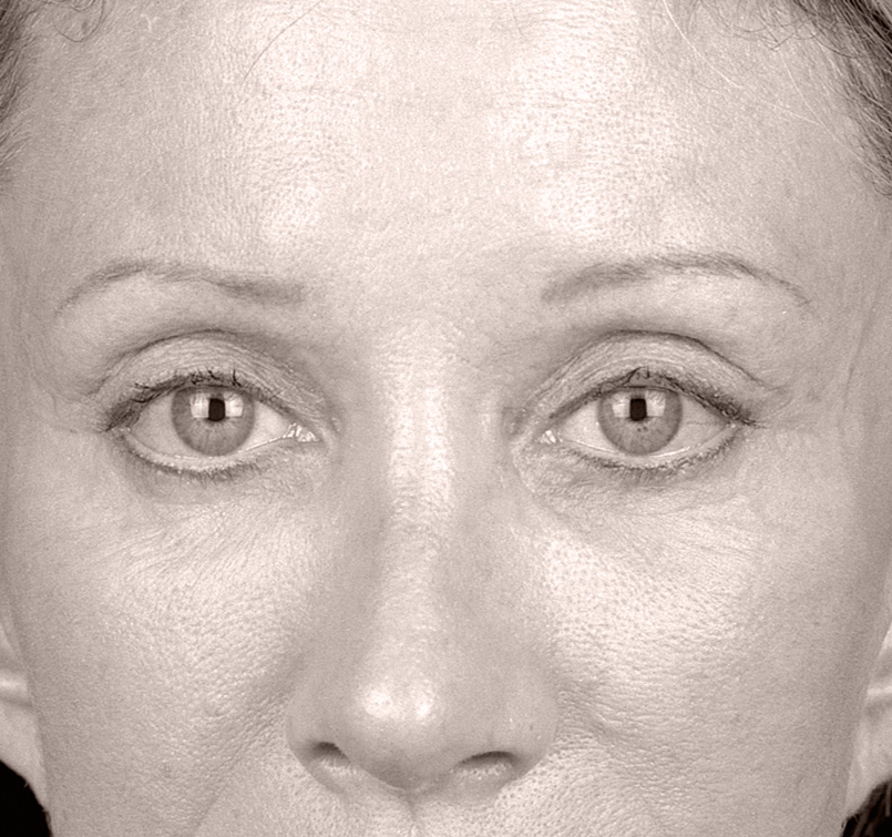 female patient after Endotine Brow, forehead procedure with brows lifted and younger look